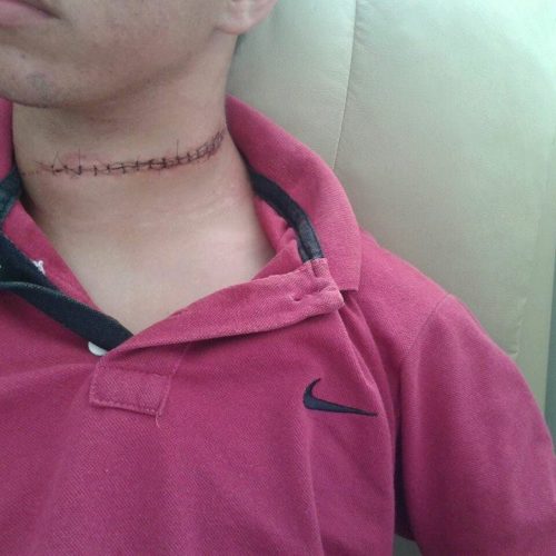 BRINCADEIRA PERIGOSA: Adolescente tem pescoço cortado por linha com cerol