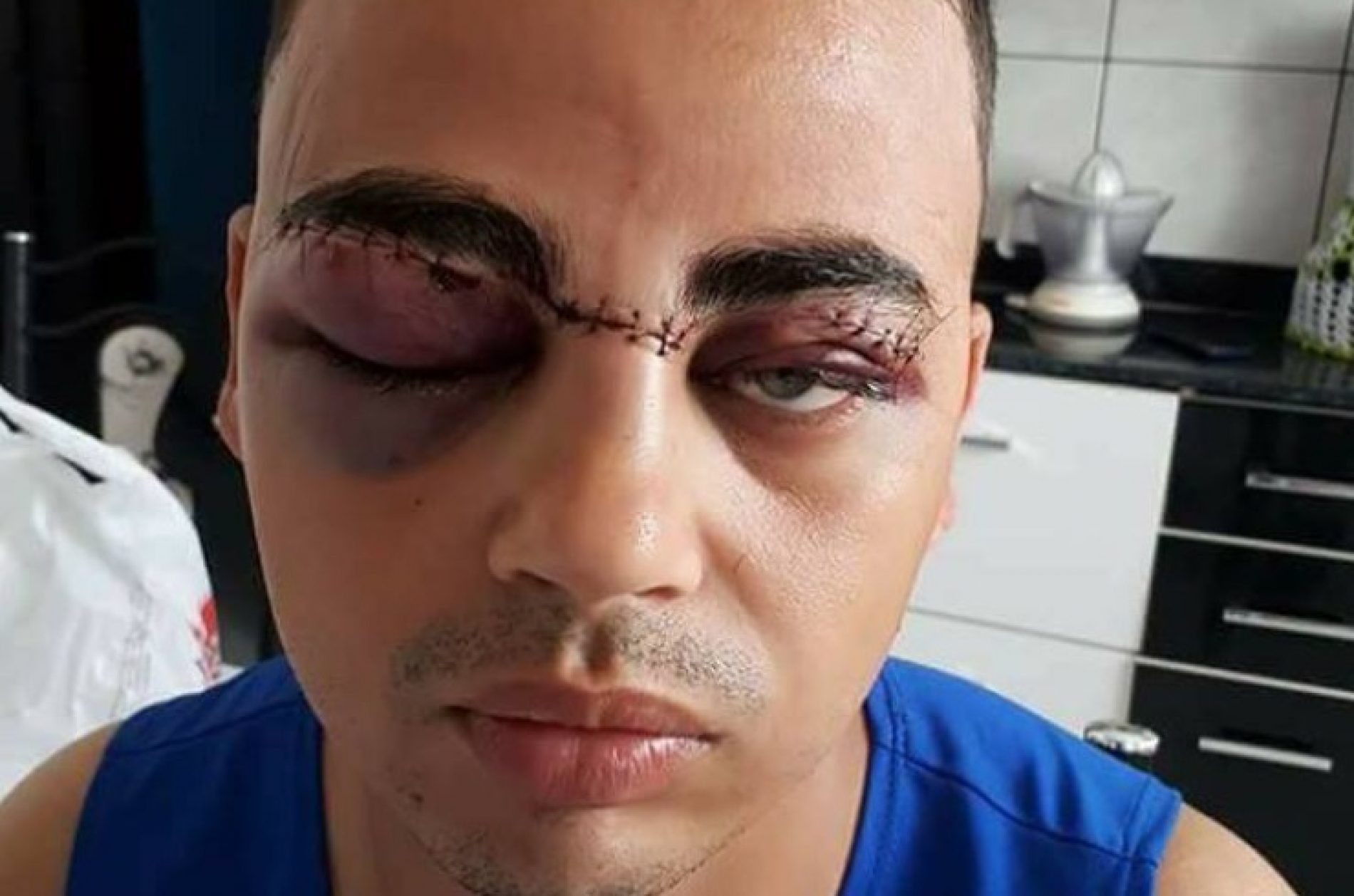 REGIÃO: Jovem tem rosto cortado por cerol e expõe risco em rede social