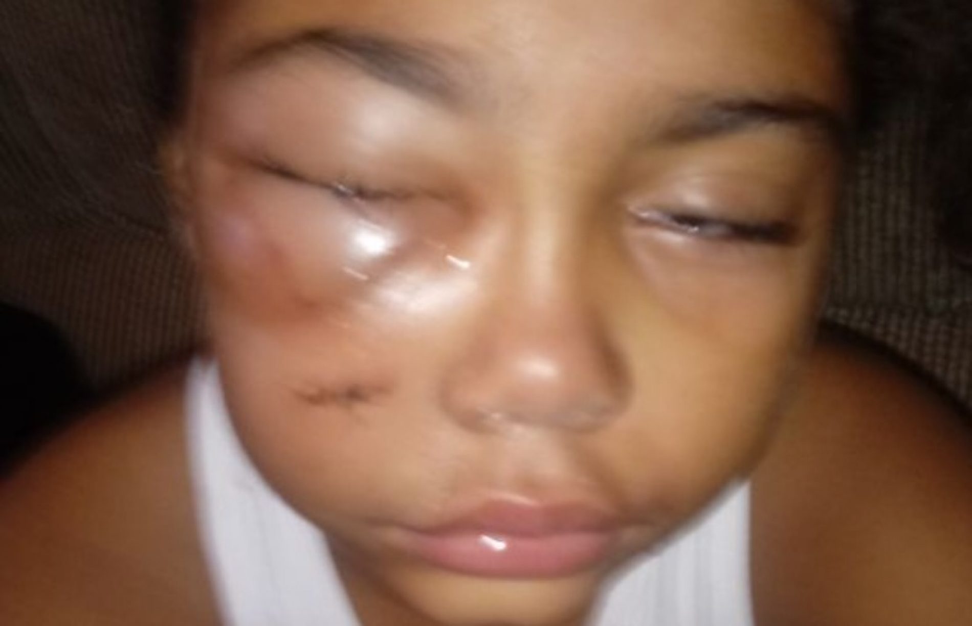 REGIÃO: Pit bull ataca criança de 7 anos
