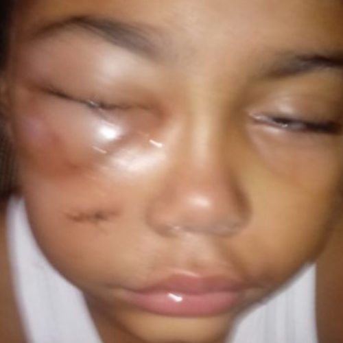 REGIÃO: Pit bull ataca criança de 7 anos