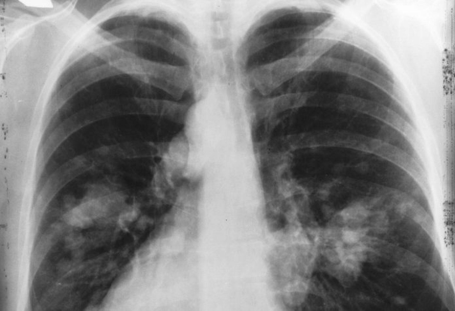 SAÚDE: Novo exame identifica câncer de pulmão com maior precisão