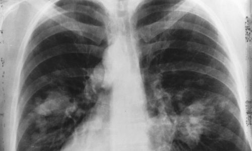 SAÚDE: Novo exame identifica câncer de pulmão com maior precisão
