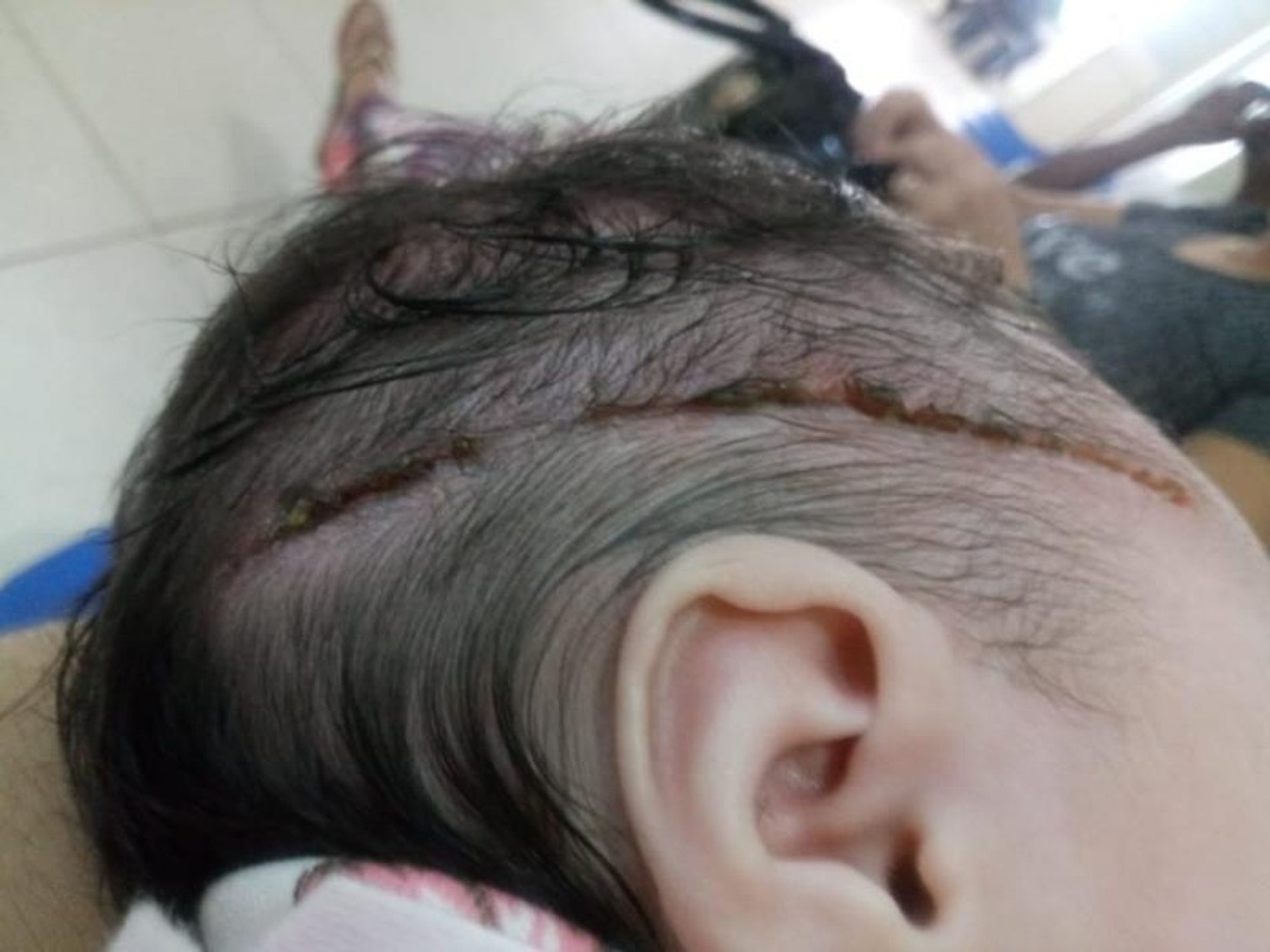 REGIÃO: Recém-nascida leva 25 pontos na cabeça após ser cortada com bisturi durante parto