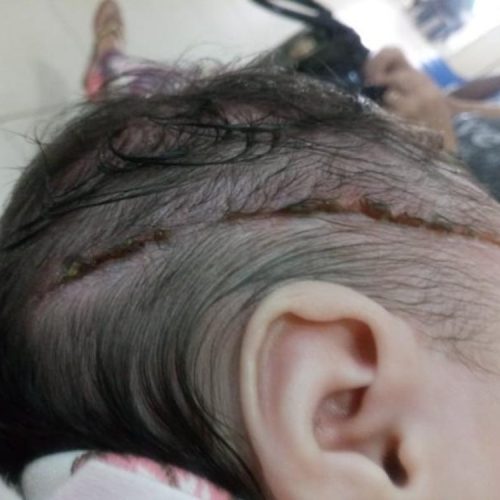 REGIÃO: Recém-nascida leva 25 pontos na cabeça após ser cortada com bisturi durante parto