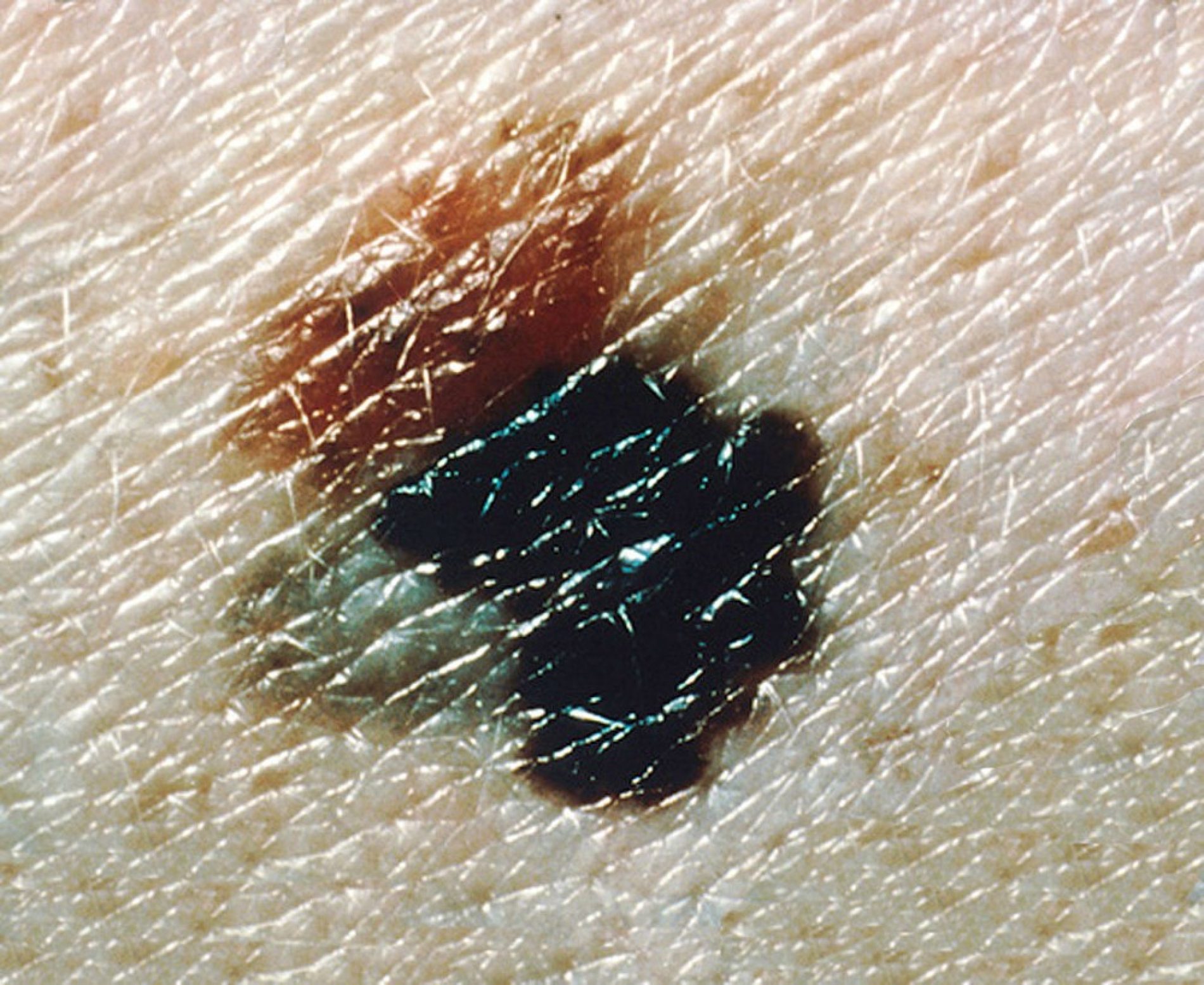 SAÚDE: Taxa de mortalidade por melanoma aumentou em homens, diz estudo