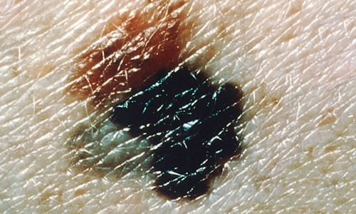 SAÚDE: Taxa de mortalidade por melanoma aumentou em homens, diz estudo