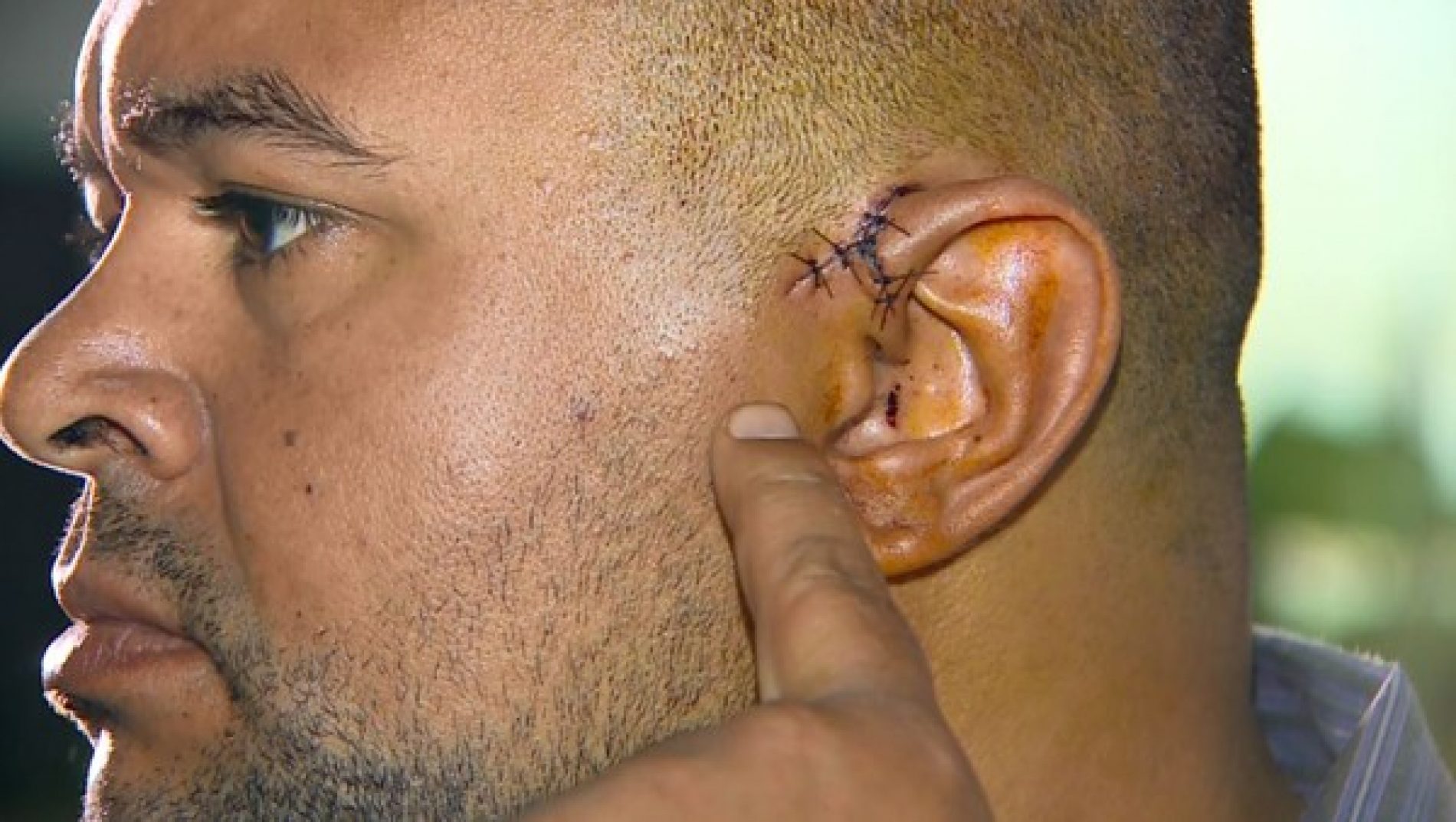 REGIÃO: Homem quase perdeu orelha com garrafada dada por criminosos