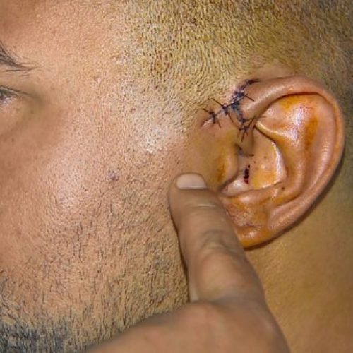REGIÃO: Homem quase perdeu orelha com garrafada dada por criminosos