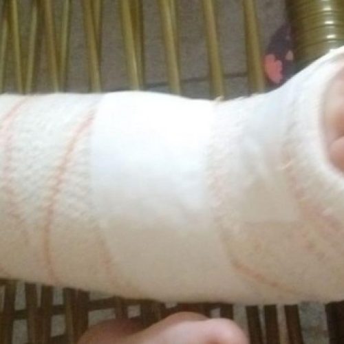 REGIÃO: Mãe registra BO por lesão corporal e omissão de socorro após bebê de 1 ano quebrar pé em creche