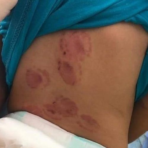 SEVERÍNIA: Mãe de bebê entregue por creche com mais de 10 marcas de mordida relata susto ao ver filho: ‘Inexplicável’