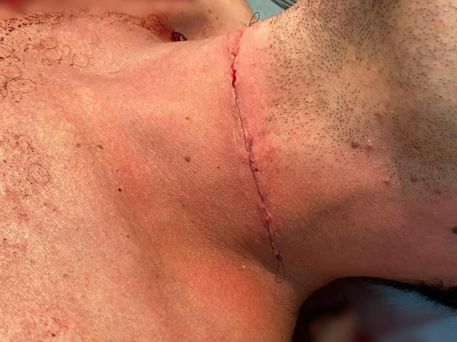 REGIÃO: Motociclista tem pescoço cortado por linha com cerol