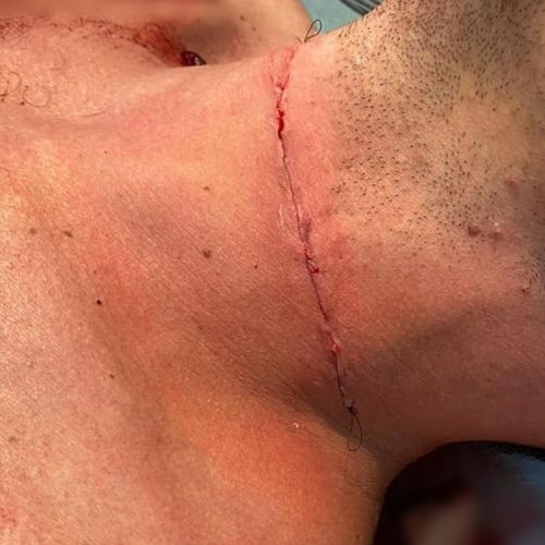 REGIÃO: Motociclista tem pescoço cortado por linha com cerol