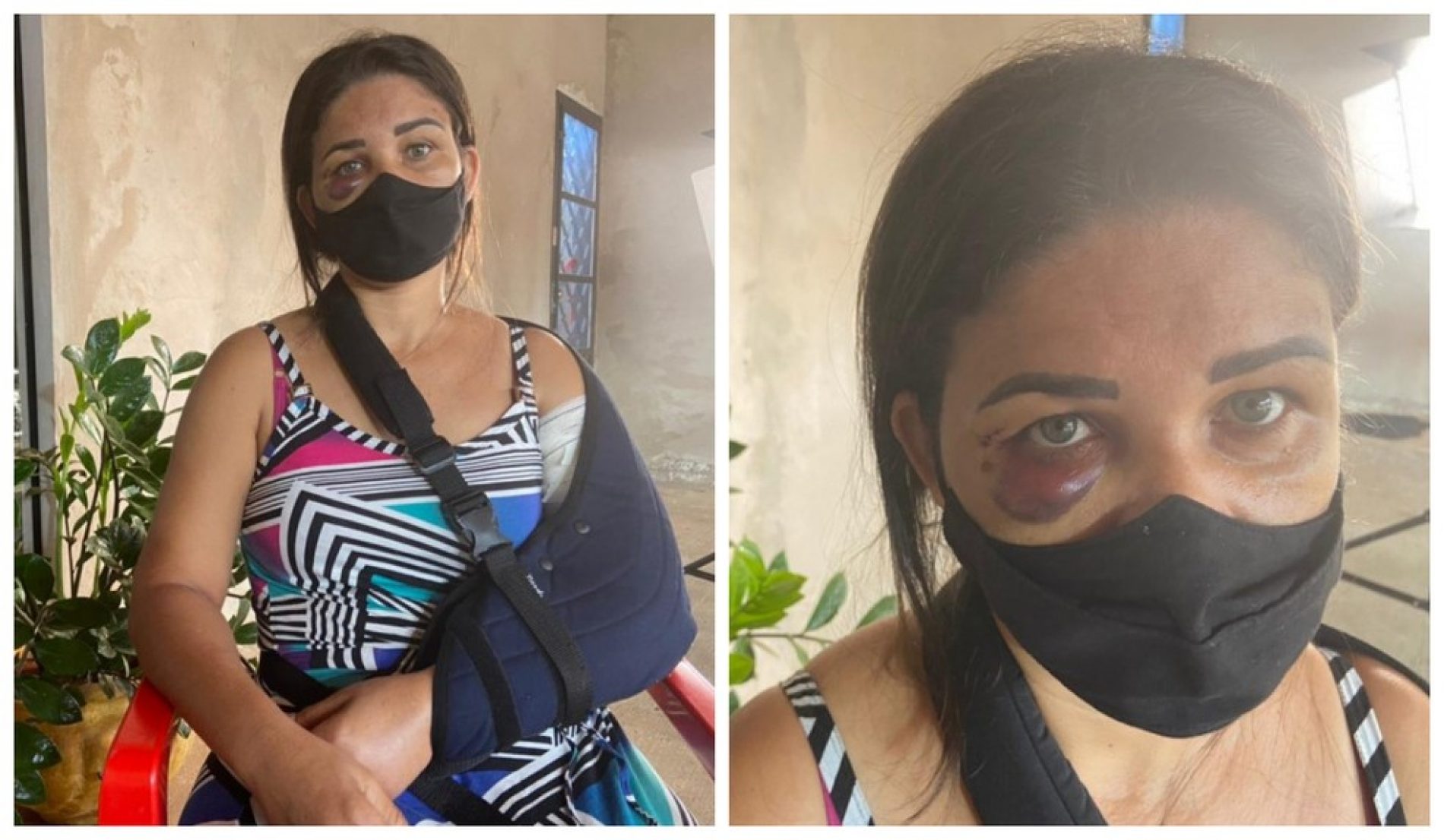 PALMARES PAULISTA: Funcionária de padaria tem braço quebrado por cliente após pedir para homem usar máscara