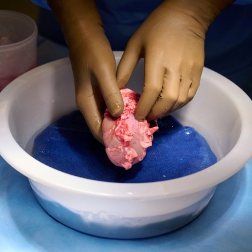 Em feito inédito, cirurgiões dos EUA testam com sucesso transplante de rim de porco em humano